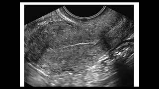 Assessment of endometrium by ultrasonography [upl. by Onimod328]