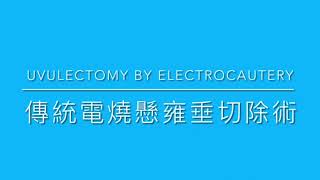 Uvulectomy by electrocautery under local anesthesia for snoring局部麻醉下電燒應用於打呼病患的懸雍垂切除 [upl. by Aissilem157]