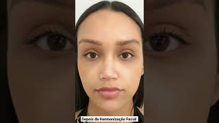 Harmonização Facial Antes e Depois sutil e Elegante shorts harmonizacaofacial estetica [upl. by Bonn997]