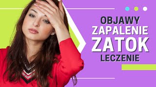 Zapalenie zatok leczenie 🔥 objawy zapalenia zatok [upl. by Octavie303]