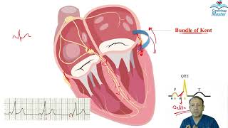 preexcitation WPW syndrome [upl. by Ahseik]