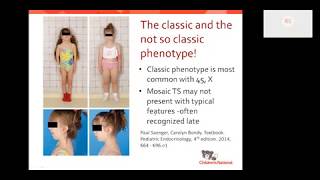 Turner syndrome Beyond the classic XO phenotype [upl. by Nidorf]