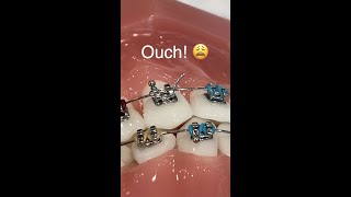 Braces Wire Poking Lips And IT HURTS SO BAD 😩 Orthodontist Reacts… [upl. by Ardnaskela]