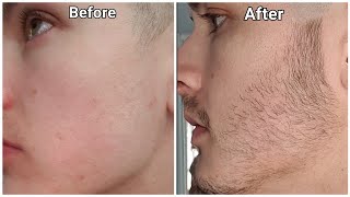 Minoxidil Beard Growth  3 Month Transformation  BEFORE and AFTER [upl. by Eseyt309]