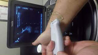 Anatomic overview of radial artery site using ultrasound Alberta Health Services [upl. by Naujahs]