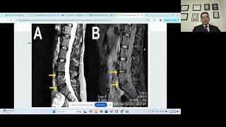 Navneet bodduRole of mesenchymal stemcells for systemic illnesses [upl. by Camilia240]