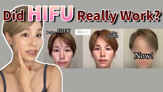 【HIFU Transformation】After 5 months [upl. by Nezah]