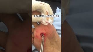 Plantar wart removal by thermocautery ازالة عين السمكة بالكي [upl. by Clemmy]