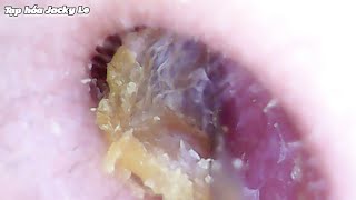 Ear Wax Removal 147 Thick earwax and lots of dead skin  Ear Cleaning ASMR Relaxing Video [upl. by Wynny]