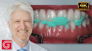 Restoration of Implant Overdentures by Timothy Kosinski DDS MAGD [upl. by Nerac]