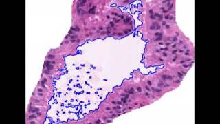 ExpectationMaximization driven Level Set Model for Gland Segmentation on Prostate Histology Images [upl. by Nomad]