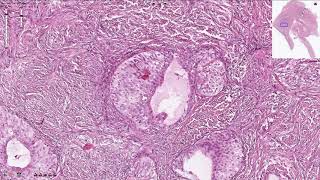 Brenner Tumor  Ovary Histopathology [upl. by Gaston250]