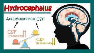 Hydrocephalus  What can cause hydrocephalus  Communicating vs non communicating hydrocephalus [upl. by Joly799]