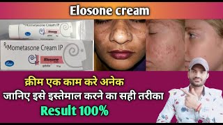 Eloson cream use benefits and Side effects full review in hindiMometasone01 [upl. by Cannice]