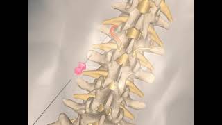 What is lumbar facet Radiofrequency ablation Treatment for lower back pain [upl. by Steffen]