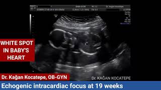 Echogenic intracardiac focus on fetal ultrasound Is it a heart disease When will it go away [upl. by Enutrof]