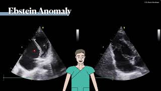 〖Echocardiography〗 Ebstein anomaly 💘 [upl. by Nimaj]