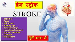 what is stroke full video in Hindi explore stroke brain braintest ischemicstroke [upl. by Hpotsirhc]