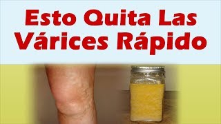 COMO QUITAR LAS VARICES RAPIDAMENTE Varices En Las Piernas Tratamiento Natural [upl. by Vaughn468]