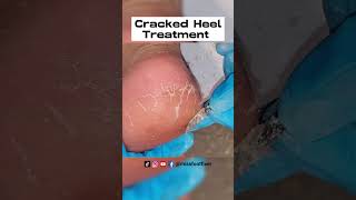 Remove Cracked Heels  So satisfying 6 mins Cracked heel treatment by miss foot fixer [upl. by Lowrie]