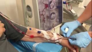 Dialysis connection of a patient with an arteriovenous fistula [upl. by Allehcim]