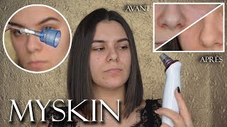 JE TESTE LASPIRATEUR À POINTS NOIRS  MYSKIN [upl. by Jennifer]