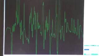 Myopathy EMG changes explained [upl. by Dituri]