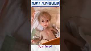 Neonatal progeria baby [upl. by Nnazil]