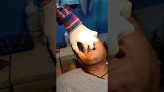 THE UPPER SECOND PREMOLAR TOOTH EXTRACTION [upl. by Tratner]