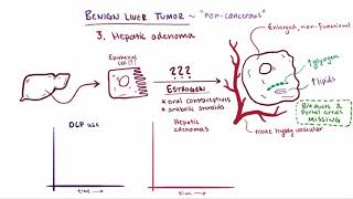 Benign liver tumors causes symptoms diagnosis treatment amp pathology [upl. by Nylimaj]