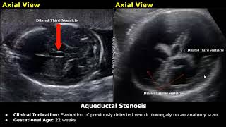 Fetal Brain Ultrasound Reporting  Obstetric Brain Pathologies Scan Reports  Pregnancy USG [upl. by Yren]