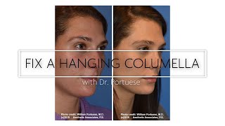 Rhinoplasty Surgery  Lifting a Hanging Columella [upl. by Lucille]