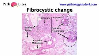 Path Bites  Fibrocystic change [upl. by Enoob]