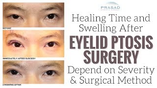 Factors that Affect Healing Time and Temporary Swelling of Eyelid Ptosis Surgery [upl. by Htnicayh]