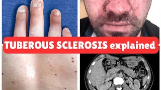 Tuberous Sclerosis Complex TSC Recognizing Adenoma Sebaceum and Other Clinical Signs [upl. by Allenotna]