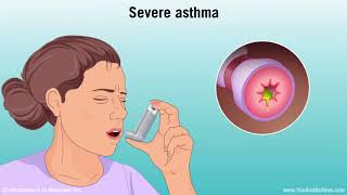 Understanding Asthma Mild Moderate and Severe [upl. by Nidya]