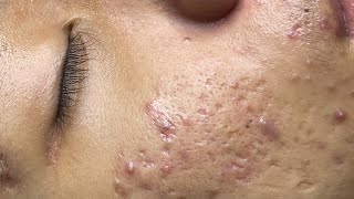 ACNE TREATMENT VU QUYNH MI Acne On Boys Nose 2024 [upl. by Eserehs]