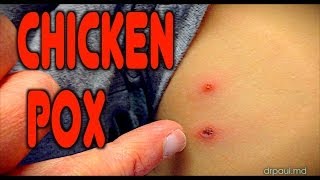 CHICKENPOX Live Diagnosis  Dr Paul [upl. by Press667]