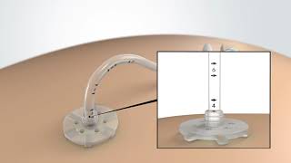 MIC PEG Tube Maintenance and Stoma Care [upl. by Nettirb]