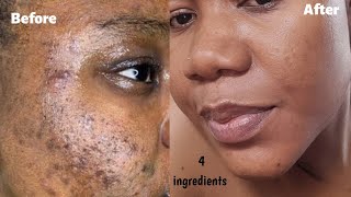 GET RID OF PIMPLES amp ACNE IN 7 DAYS  How to fade darkspots amp get a clear glowing skin [upl. by Oca297]