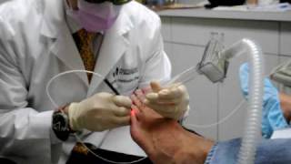 Pinpointe Patholase Laser for Toenail Fungus [upl. by Kassie]