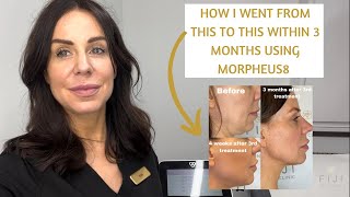 Is Morpheus8 worth it Before amp After of Morpheus8 Radiofrequency amp Microneedling Review [upl. by Rem]