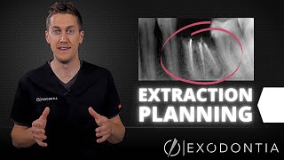 How To Extract Teeth Successfully Every Time  OnlineExodontiacom [upl. by Afinom]