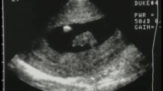 Sonography of first Trimester Pregnancy [upl. by Elamef]