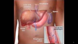 Upper Gastrointestinal Bleed  Hematemesis [upl. by Eessac523]