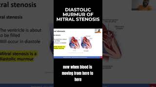 Diastolic Murmur of Mitral Stenosis  MCCQE1 [upl. by Yriek]