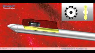 STEREOTACTIC VACUUM BIOPSY VAB [upl. by Ricketts]