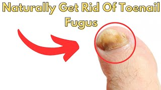 Naturally Get Rid Of Toenail Fungus Fast [upl. by Michaele139]