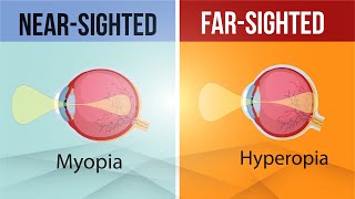 Difference in Myopia and Hyperopia  Nearsighted and FarSighted Lens  Class 10  Letstute CBSE [upl. by Evyn]