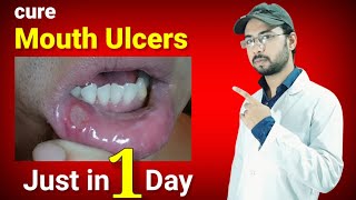 cure mouth ulcers just in one day permanently  mouth ulcer home remedy  canker sore home remedy [upl. by Singleton]